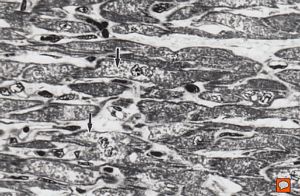 M, 7w. | mitochondrial cardiomyopathy - semithin section(arrows - megamitochondria)